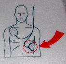 aed pad placement on lower left of torso