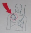 aed pad placement on upper right of torso