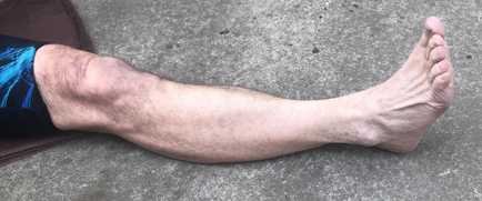 leg with flexed ankle