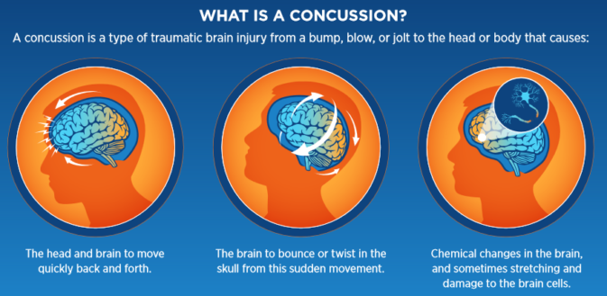 3 drawings of concussion