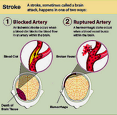 drawings of blocked arteries