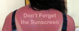 don't forget the sunscreen typed on a back with sunburn