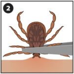 three drawings of removing a tick