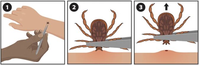 three drawings of removing a tick